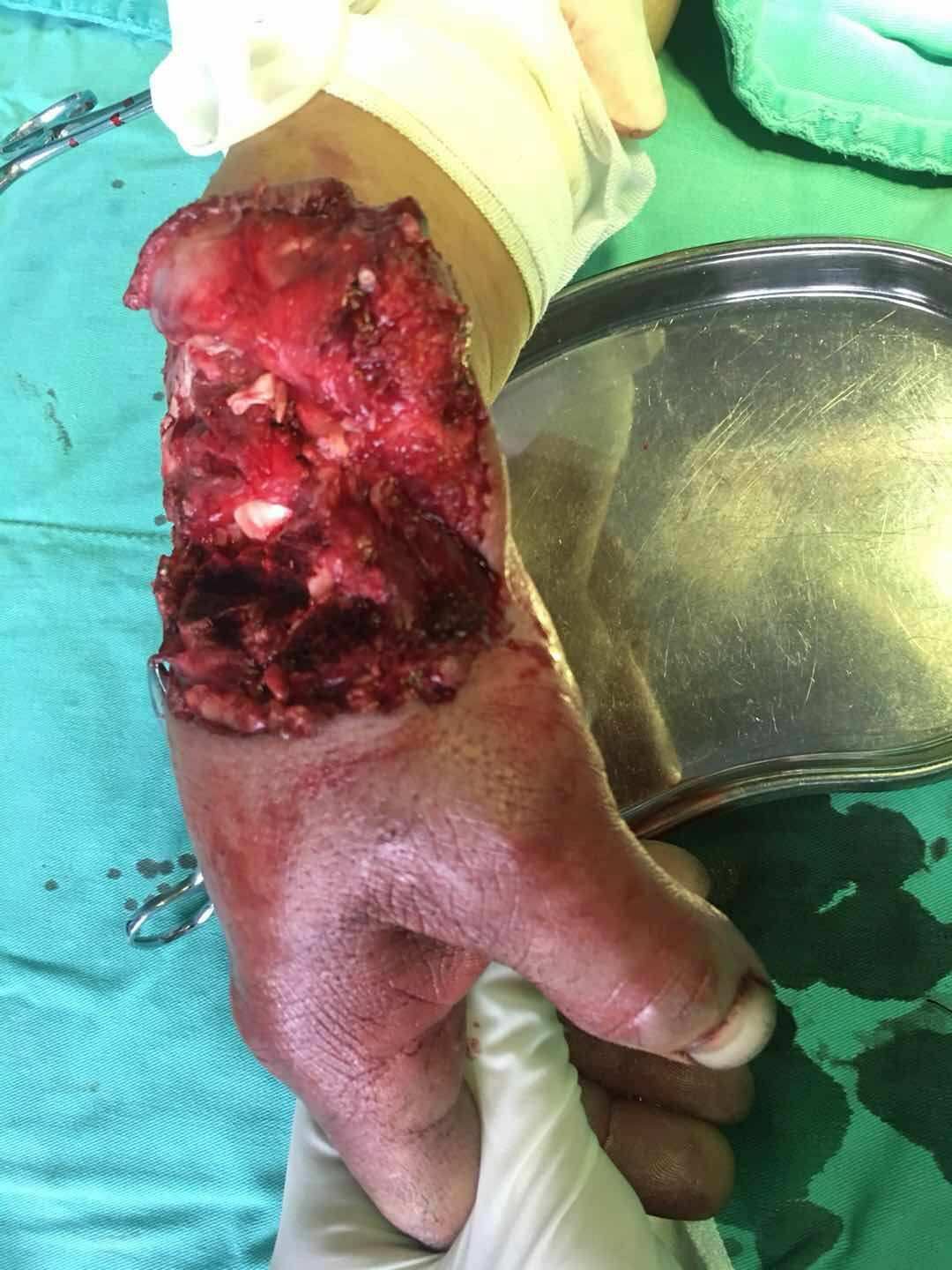 交通意外引起的肝破裂脾破裂屬于_簡述外傷性肝脾破裂的急救流程_外傷性肝脾破裂