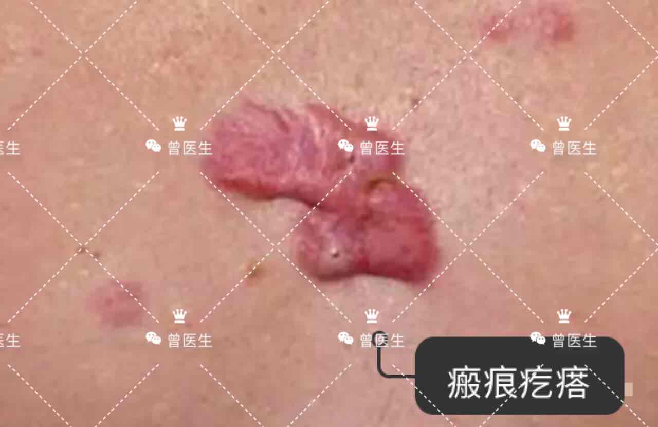 軍校體檢疤痕要求_疤痕體檢軍校要求多少錢_疤痕體檢軍校要求什么